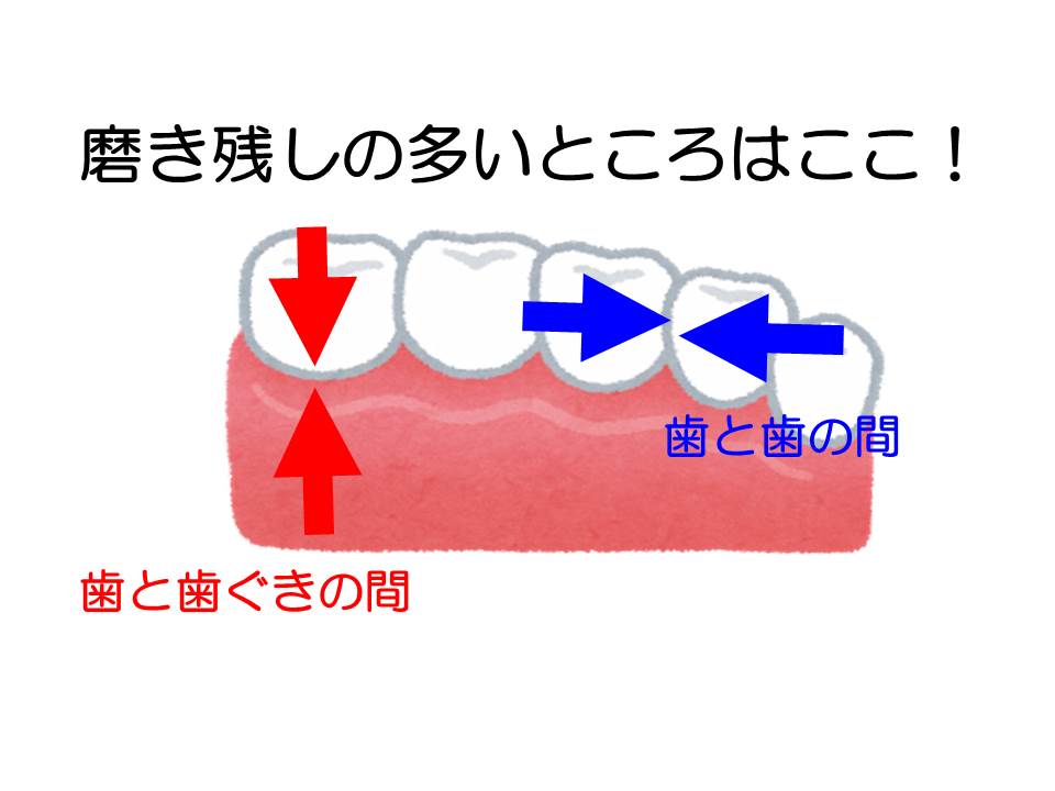 みがき残しのあるところ